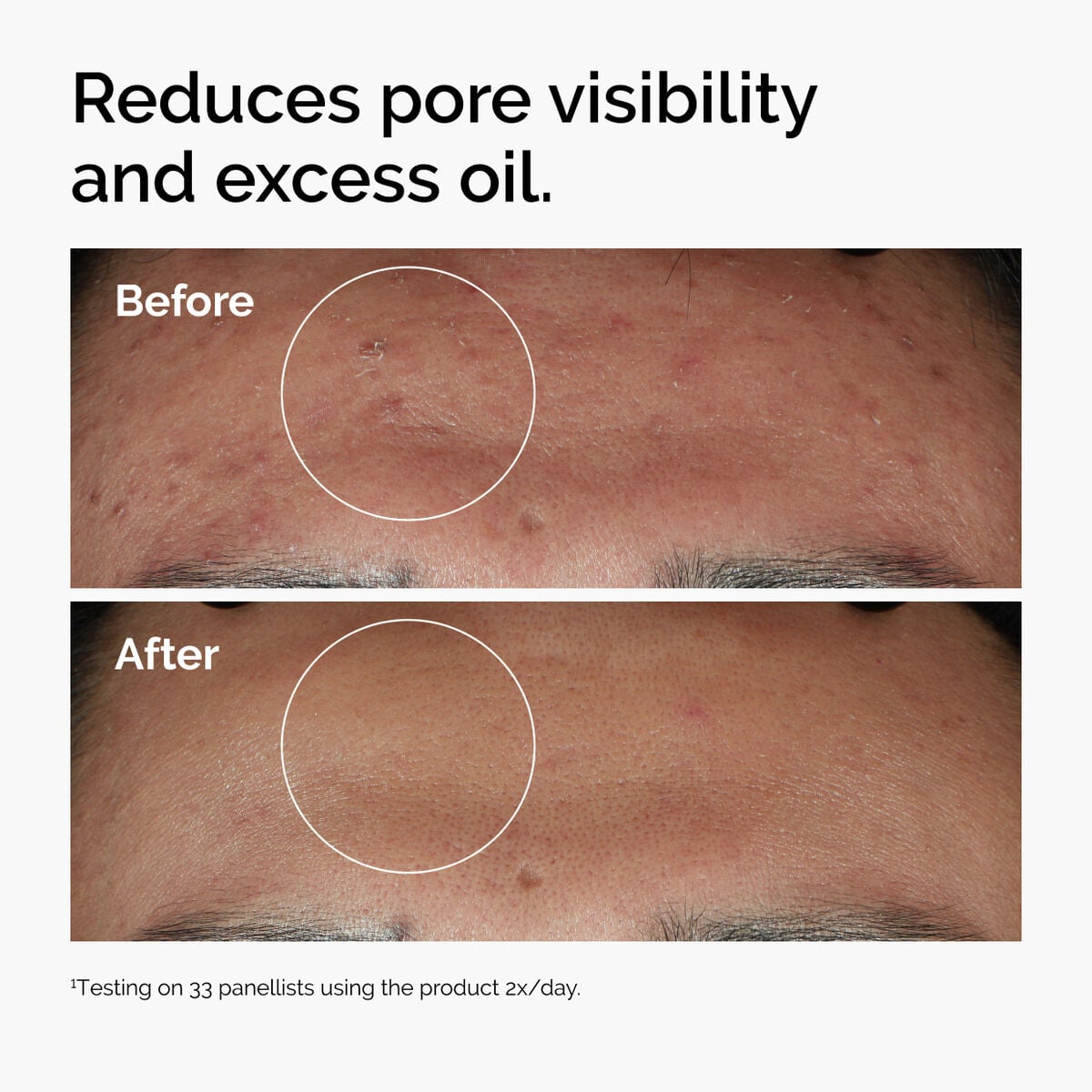 niacinamide-10-zinc-1-g7 ord-niacinamide-zinc-blemish-serum-before-after-pores.jpg