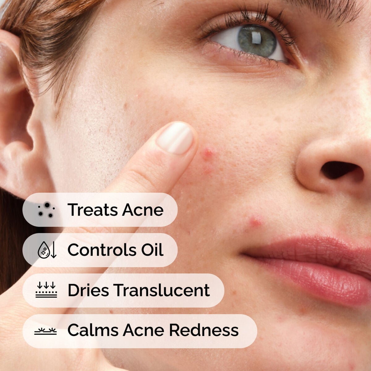 sulfur-10-powder-to-cream-concentrate-y4 ord-sulfur-10pct-powder-to-cream-concentrate-model-application-with-benefits-acne.jpg