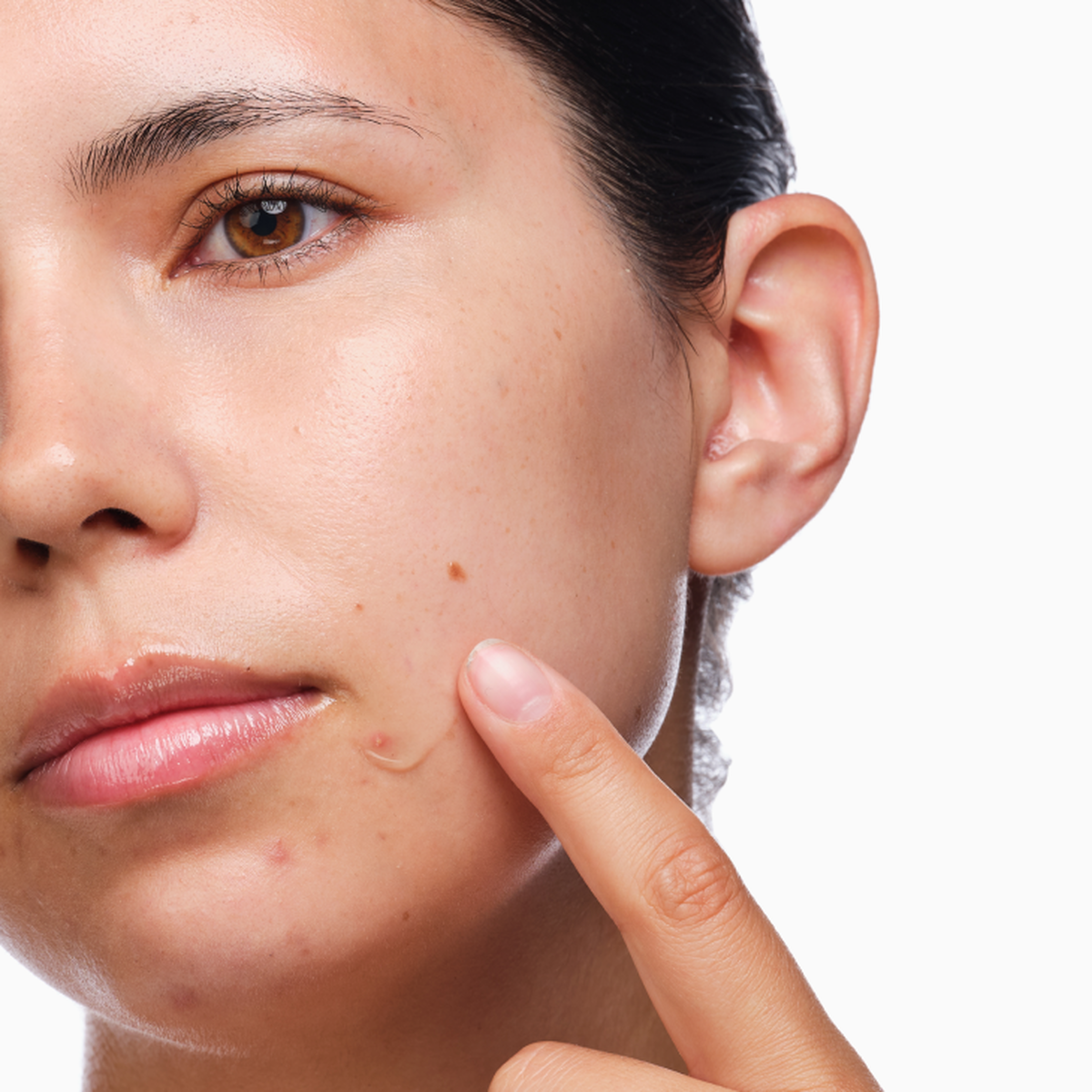 the-acne-set-x7 rdn-the-acne-set-application.png